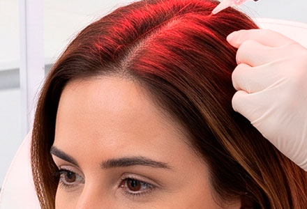 Mesoterapia y bioestimulación capilar